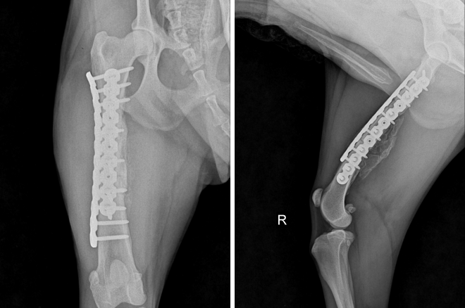 골절된 대퇴골 수술후 X-ray 사진