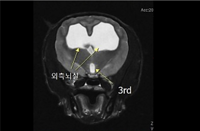 원 내 MRI 검사로 확인된 뇌수두증 사진1
