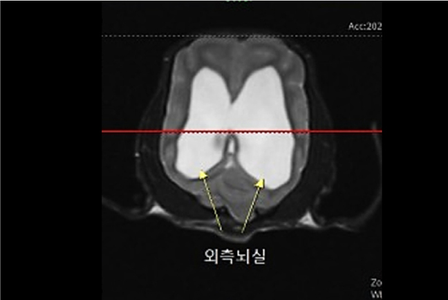 원 내 MRI 검사로 확인된 뇌수두증 사진2