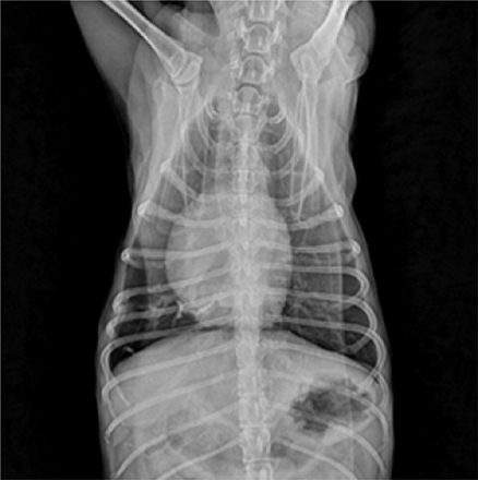 폐 종양이 제거된 흉강 X-ray 사진
