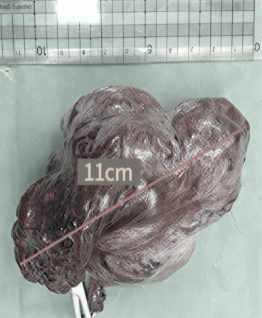 제거 후 조직검사 (Sertoli cell tumor 진단)
