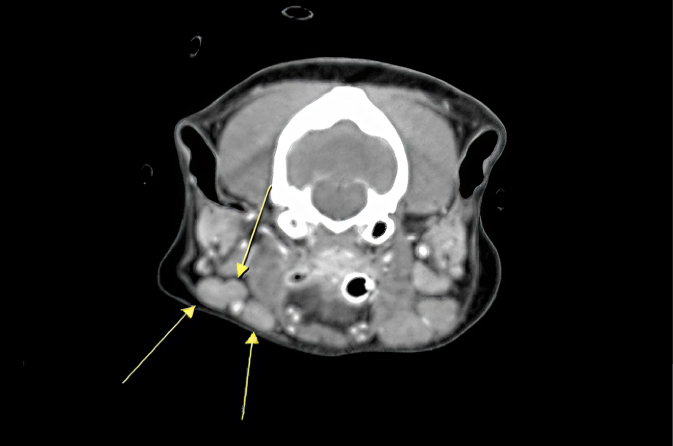 항암치료 전 비대된 하악 림프절